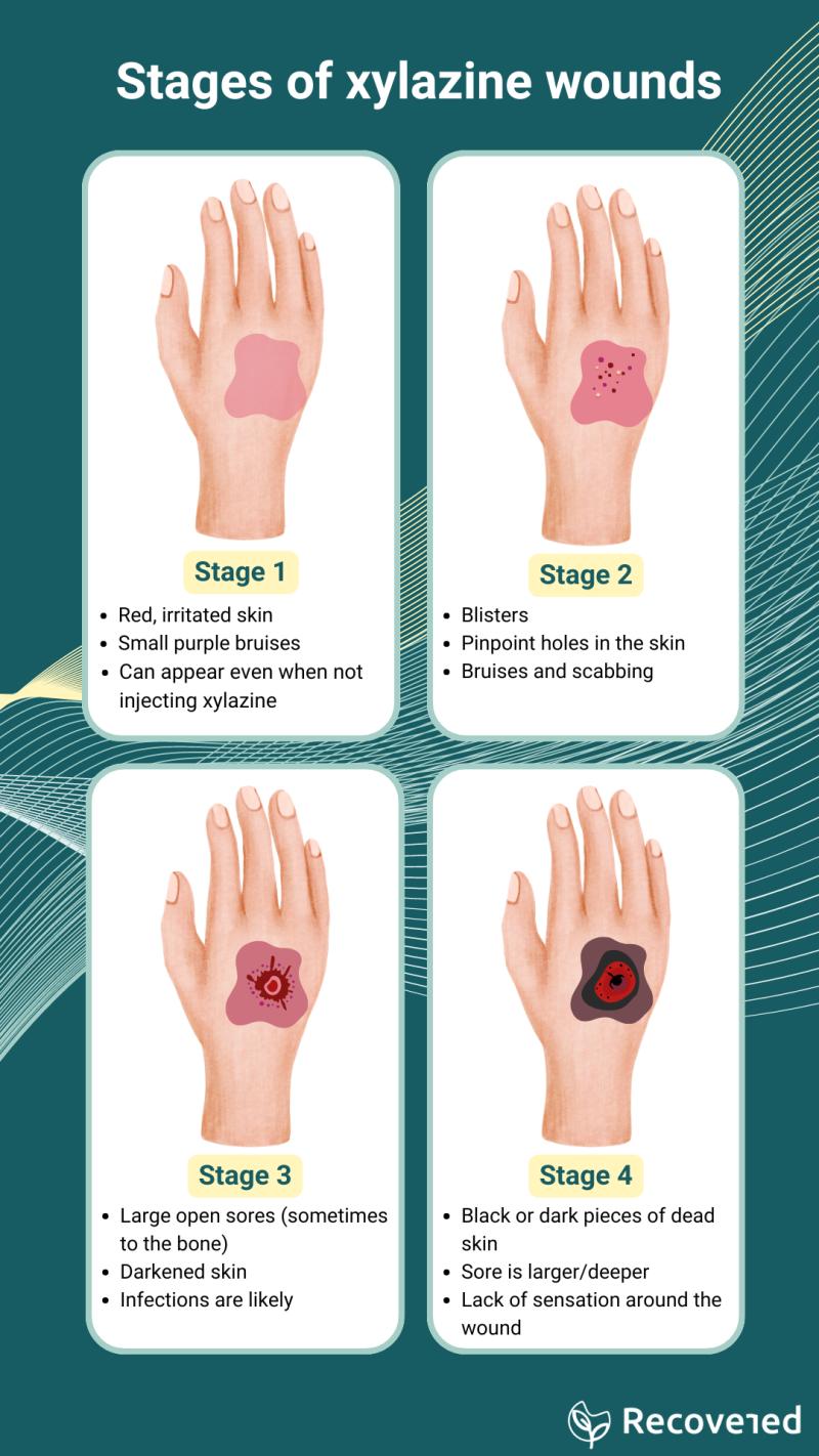 Xylazine wounds.png illustrated-representation-of-stages-of xylazine-wounds
