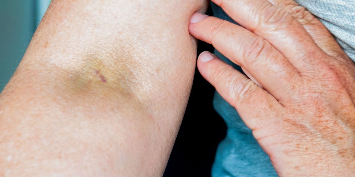 Track Marks: Identification, Health Risks, and Care