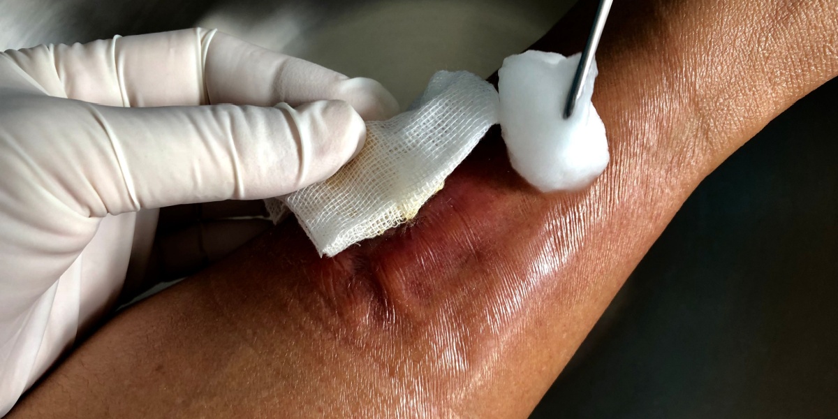 Xylazine Wounds: Appearance, Risks & Medical Treatment