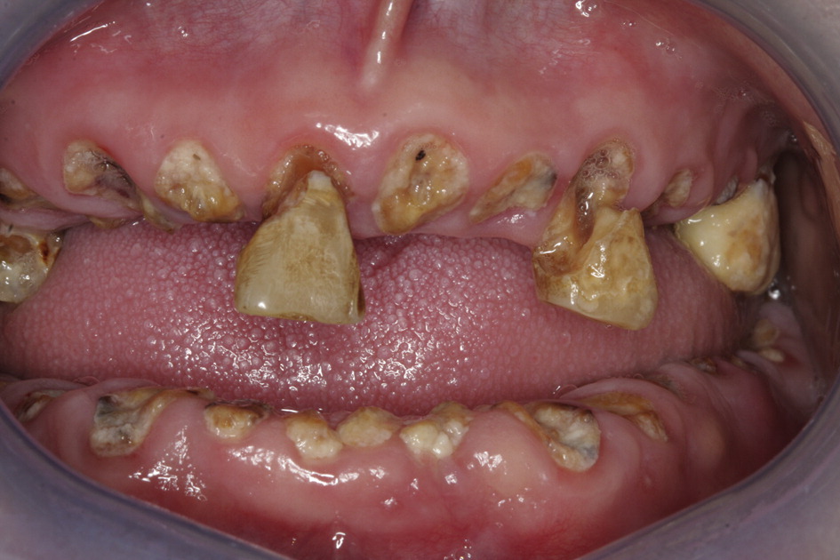 Extensive tooth decay from meth use