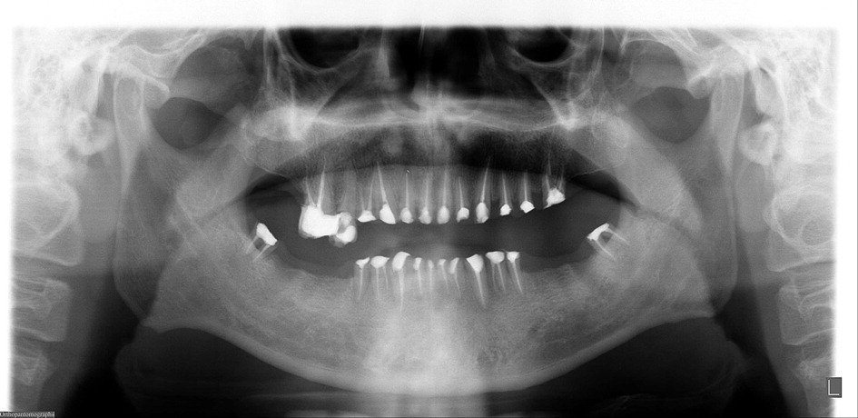 panoramic radiograph of postoperative root canal on meth mouth patient