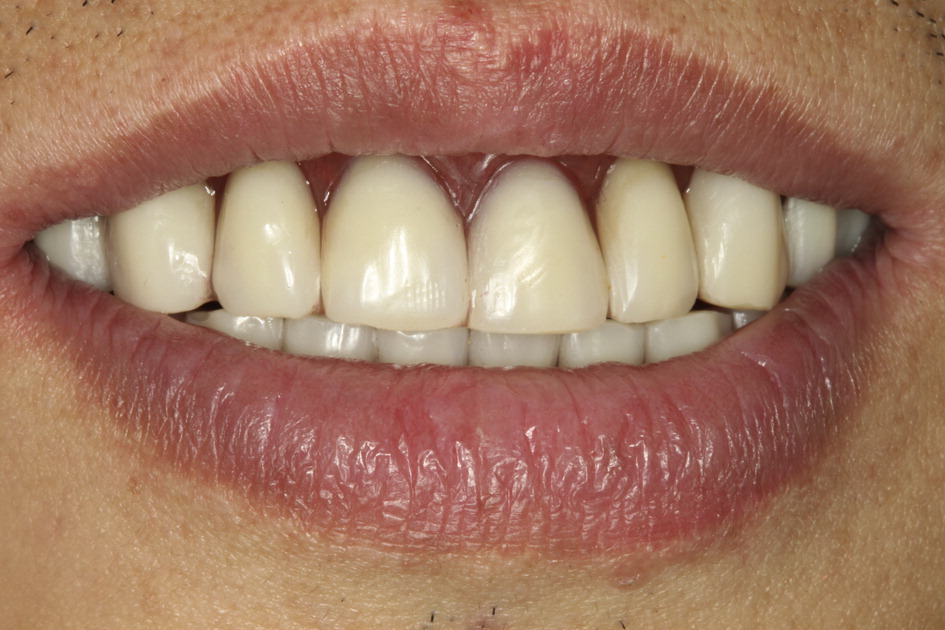 overdentures in patient with previous meth mouth tooth decay